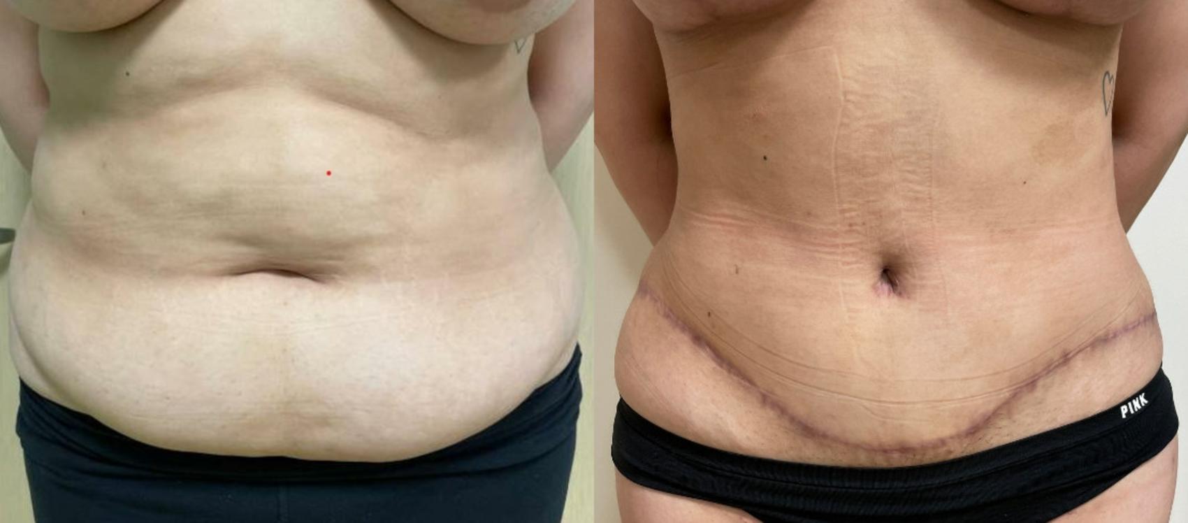 Tummy Tuck Before & After Photo | San Francisco, CA | Kaiser Permanente Cosmetic Services