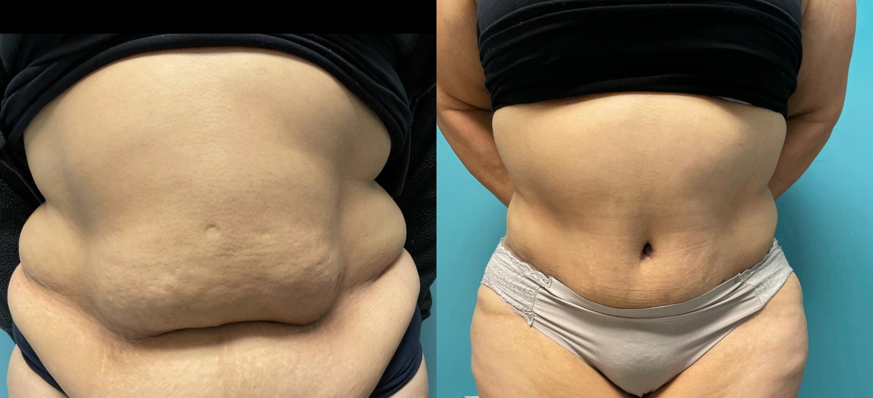 Tummy Tuck Before & After Photo | San Francisco, CA | Kaiser Permanente Cosmetic Services