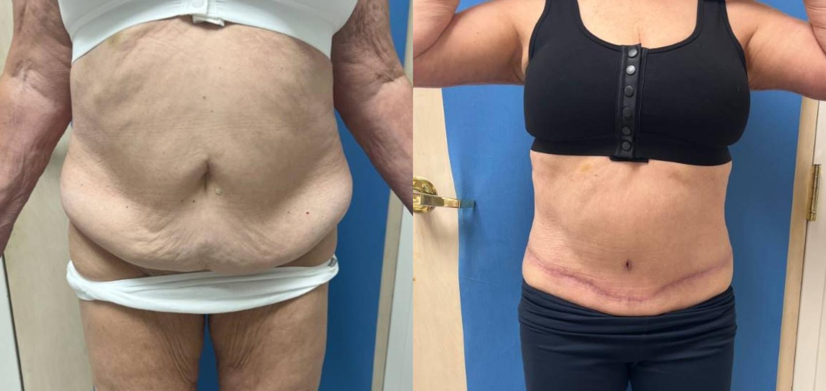 Tummy Tuck Before & After Photo | San Francisco, CA | Kaiser Permanente Cosmetic Services