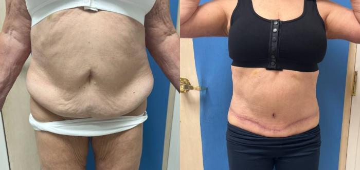 Tummy Tuck Before & After Photo | San Francisco, CA | Kaiser Permanente Cosmetic Services