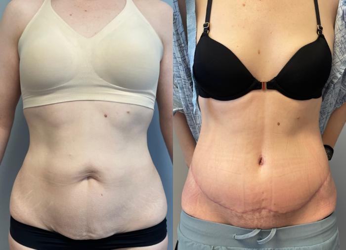 Tummy Tuck Before & After Photo | San Francisco, CA | Kaiser Permanente Cosmetic Services