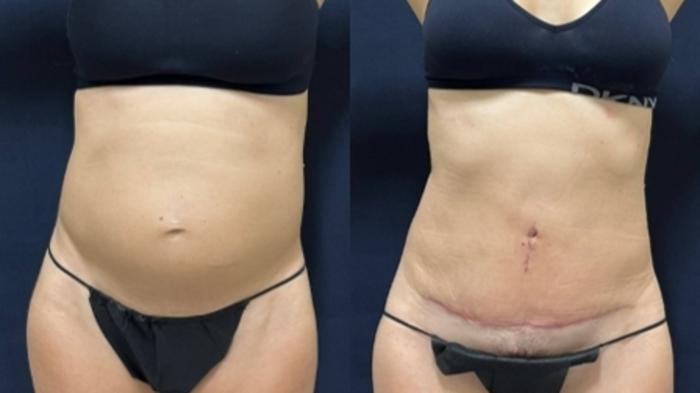 Tummy Tuck Before & After Photo | San Francisco, CA | Kaiser Permanente Cosmetic Services