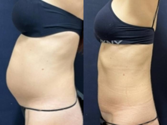 Tummy Tuck Before & After Photo | San Francisco, CA | Kaiser Permanente Cosmetic Services