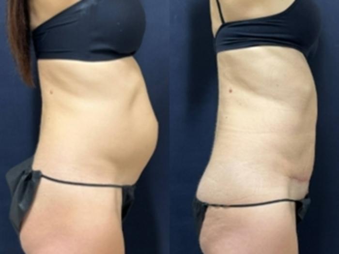 Tummy Tuck Before & After Photo | San Francisco, CA | Kaiser Permanente Cosmetic Services