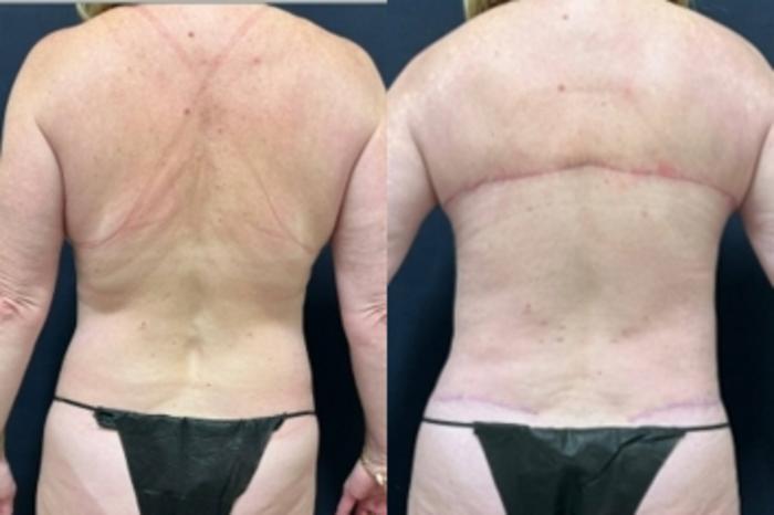 Tummy Tuck Before & After Photo | San Francisco, CA | Kaiser Permanente Cosmetic Services