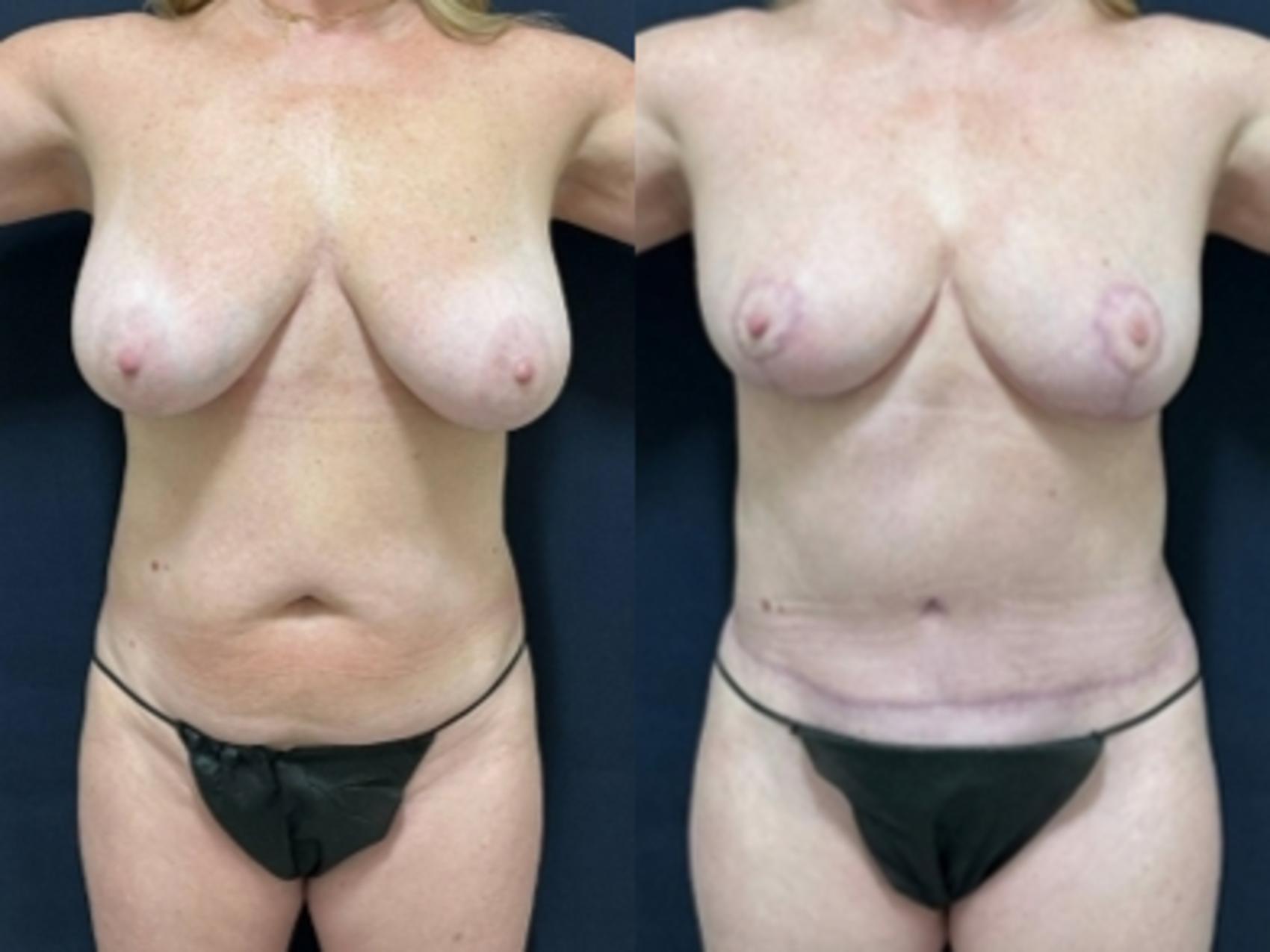 Tummy Tuck Before & After Photo | San Francisco, CA | Kaiser Permanente Cosmetic Services