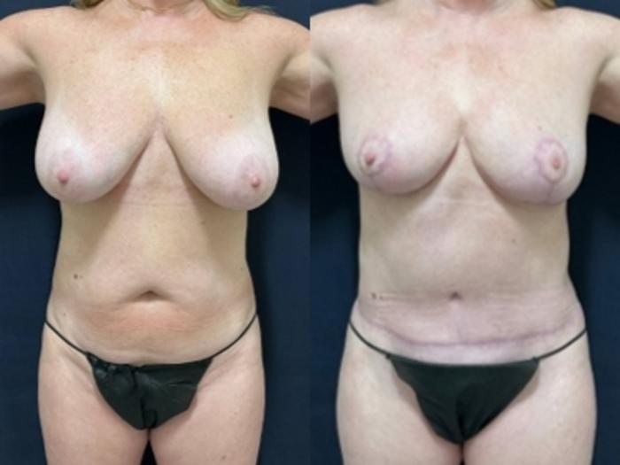 Tummy Tuck Before & After Photo | San Francisco, CA | Kaiser Permanente Cosmetic Services