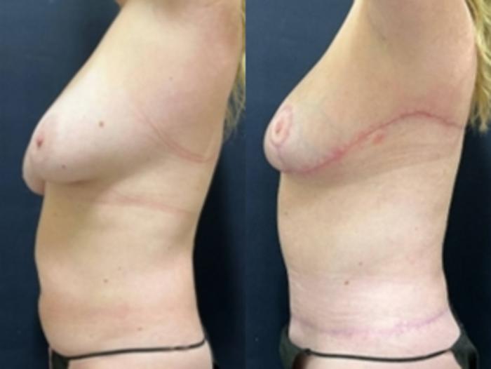 Tummy Tuck Before & After Photo | San Francisco, CA | Kaiser Permanente Cosmetic Services