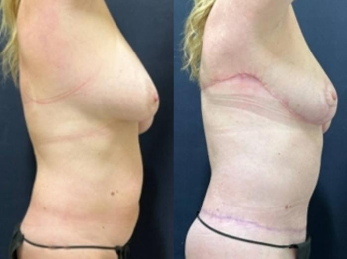Tummy Tuck Before & After Photo | San Francisco, CA | Kaiser Permanente Cosmetic Services