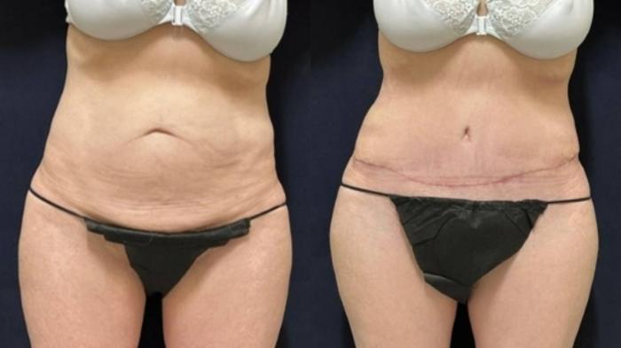 Tummy Tuck Before & After Photo | San Francisco, CA | Kaiser Permanente Cosmetic Services