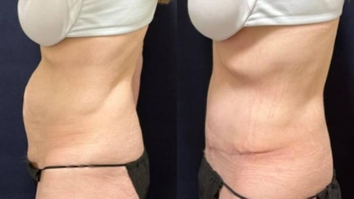 Tummy Tuck Before & After Photo | San Francisco, CA | Kaiser Permanente Cosmetic Services