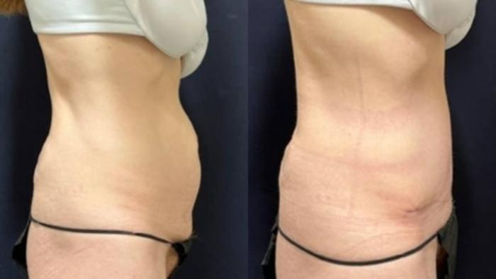 Tummy Tuck Before & After Photo | San Francisco, CA | Kaiser Permanente Cosmetic Services