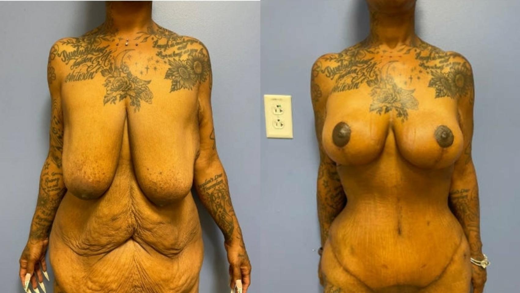 Tummy Tuck Before & After Photo | San Francisco, CA | Kaiser Permanente Cosmetic Services