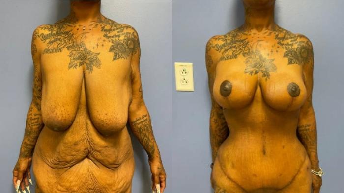 Tummy Tuck Before & After Photo | San Francisco, CA | Kaiser Permanente Cosmetic Services