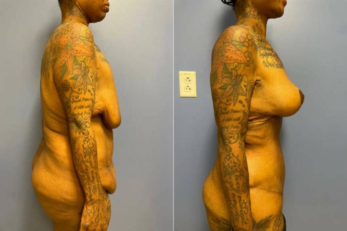Tummy Tuck Before & After Photo | San Francisco, CA | Kaiser Permanente Cosmetic Services