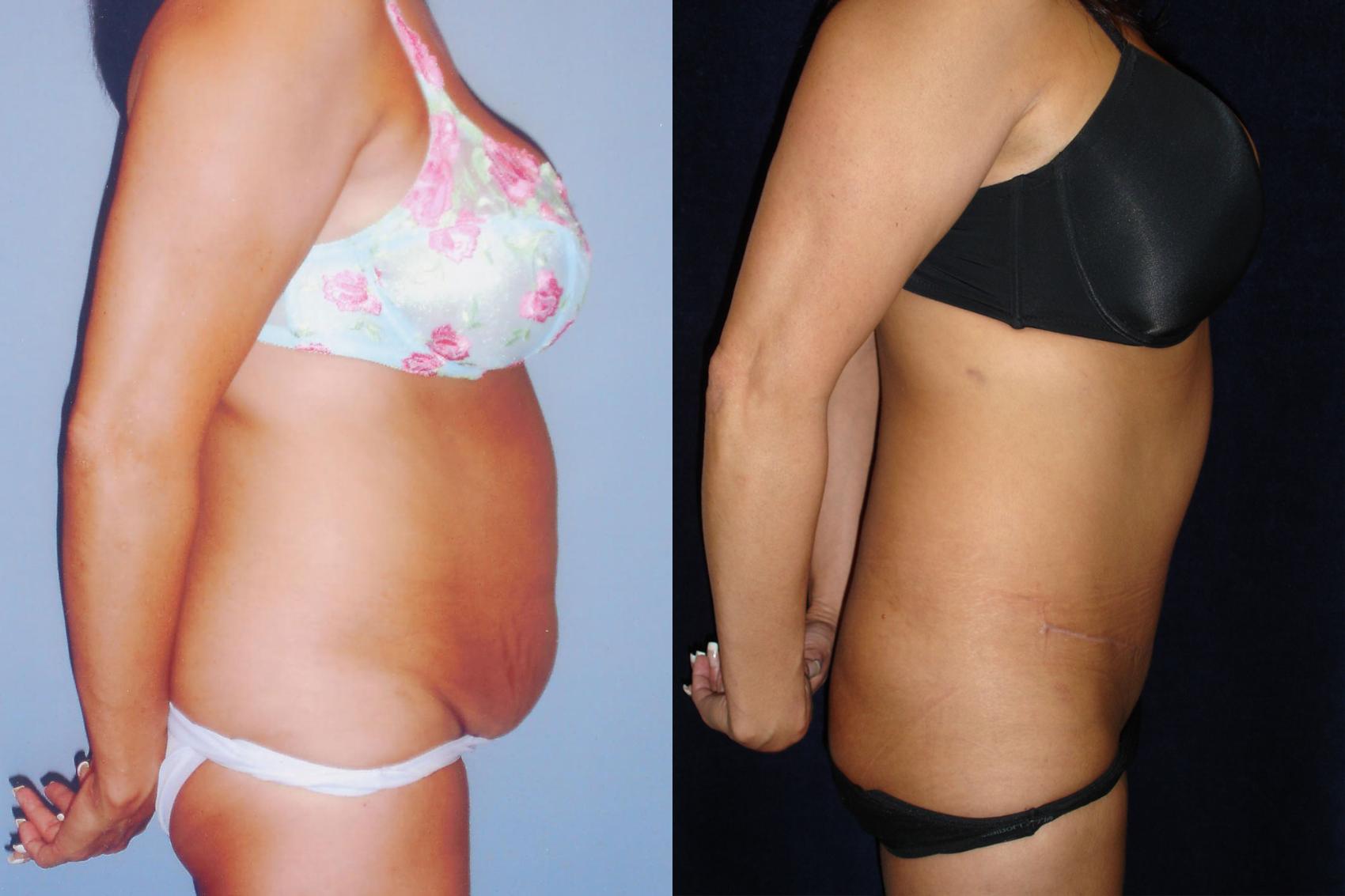 Tummy Tuck Before And After And The Average Cost Fitoont 